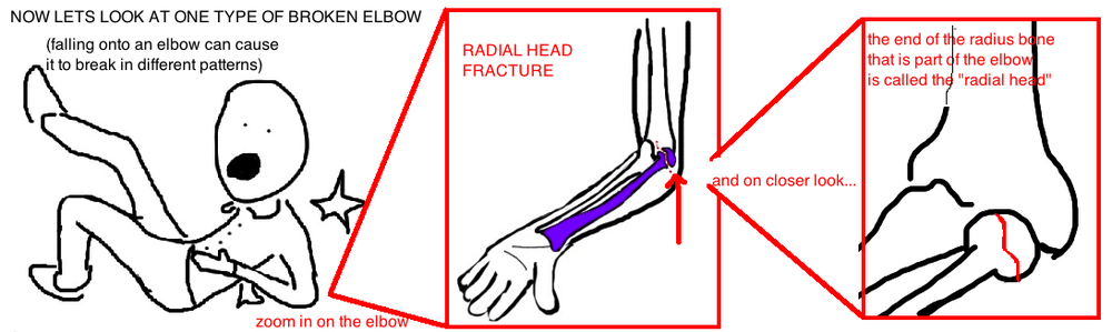 brokenelbowradialheadfracture.jpg